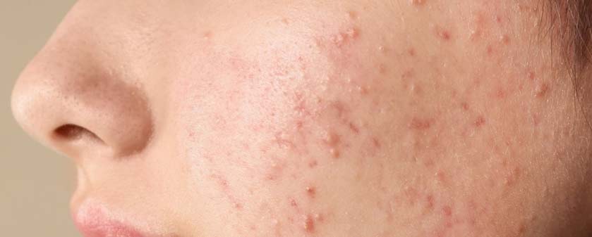 楊浩康(Yeung Ho Hong)醫生講解暗瘡