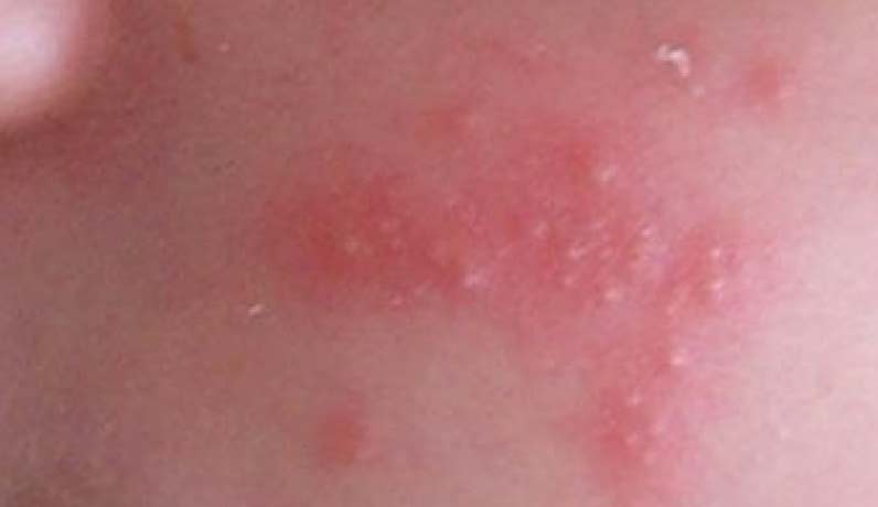 楊浩康(Yeung Ho Hong)醫生講解甚麼是新生兒痤瘡?