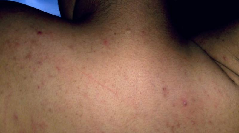 楊浩康(Yeung Ho Hong)醫生講解熱疹